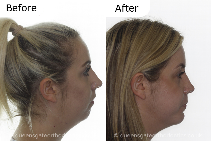 Overbite Correction and Jaw Realignment without Surgery